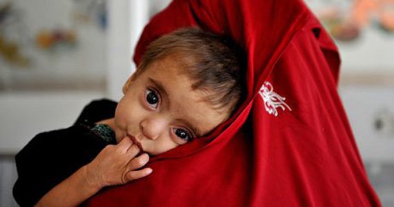 30 درصد کودکان روستایی در هرات با سوء تغذیه دست و پنجه نرم می‌نمایند