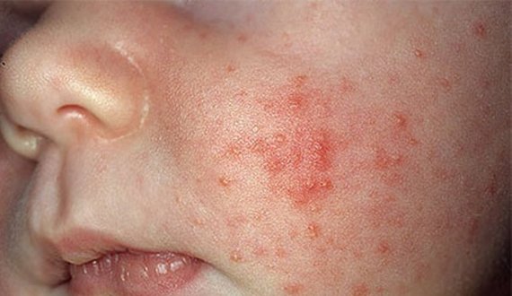 افزایش آمار مبتلایان به بیماری سرخکان در دایکندی