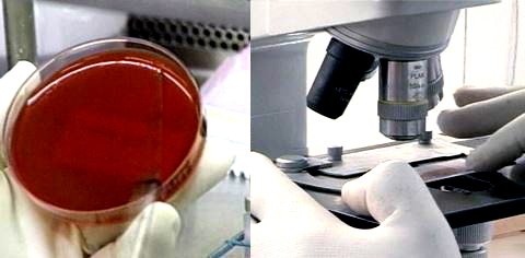 توبرکلوز سالانه جان ۱۲ هزار نفر را در افغانستان می‌گیرد