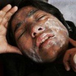 اسید پاشی به روی دو دختر دانش آموز در هرات