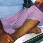 تبی که کشنده شد