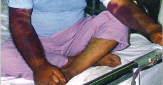 تبی که کشنده شد