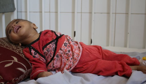 سازمان ملل متحد: یک میلیون کودک در افغانستان دچار سوء تغذیه اند
