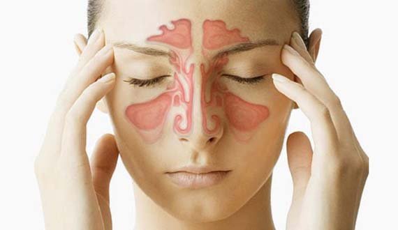 سینوزیت و علائم آن چیست؟