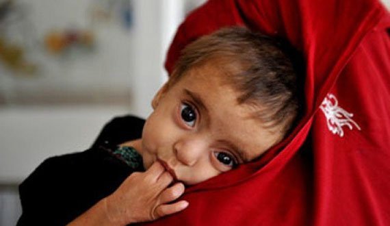 شمار بیماران سوء تغذیه در هرات کاهش یافته است