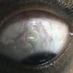 بیرون کشیدن کرم ۱۵ سانتی متری از چشم یک مرد ۶۰ ساله در هند