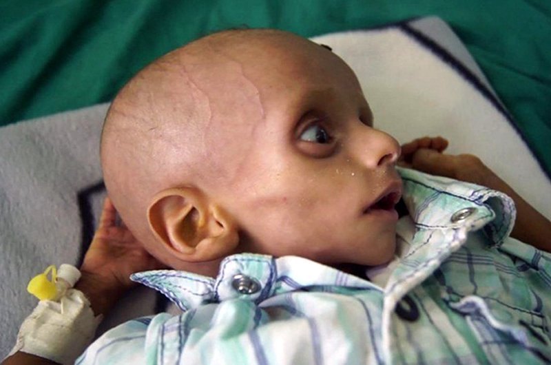 یونیسف می‌گوید ۶۰۰ هزار کودک در افغانستان سوء تغذیه شدید دارند